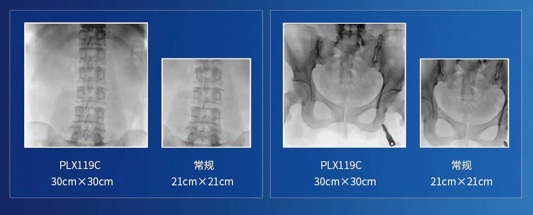 大平板C形臂視野翻倍