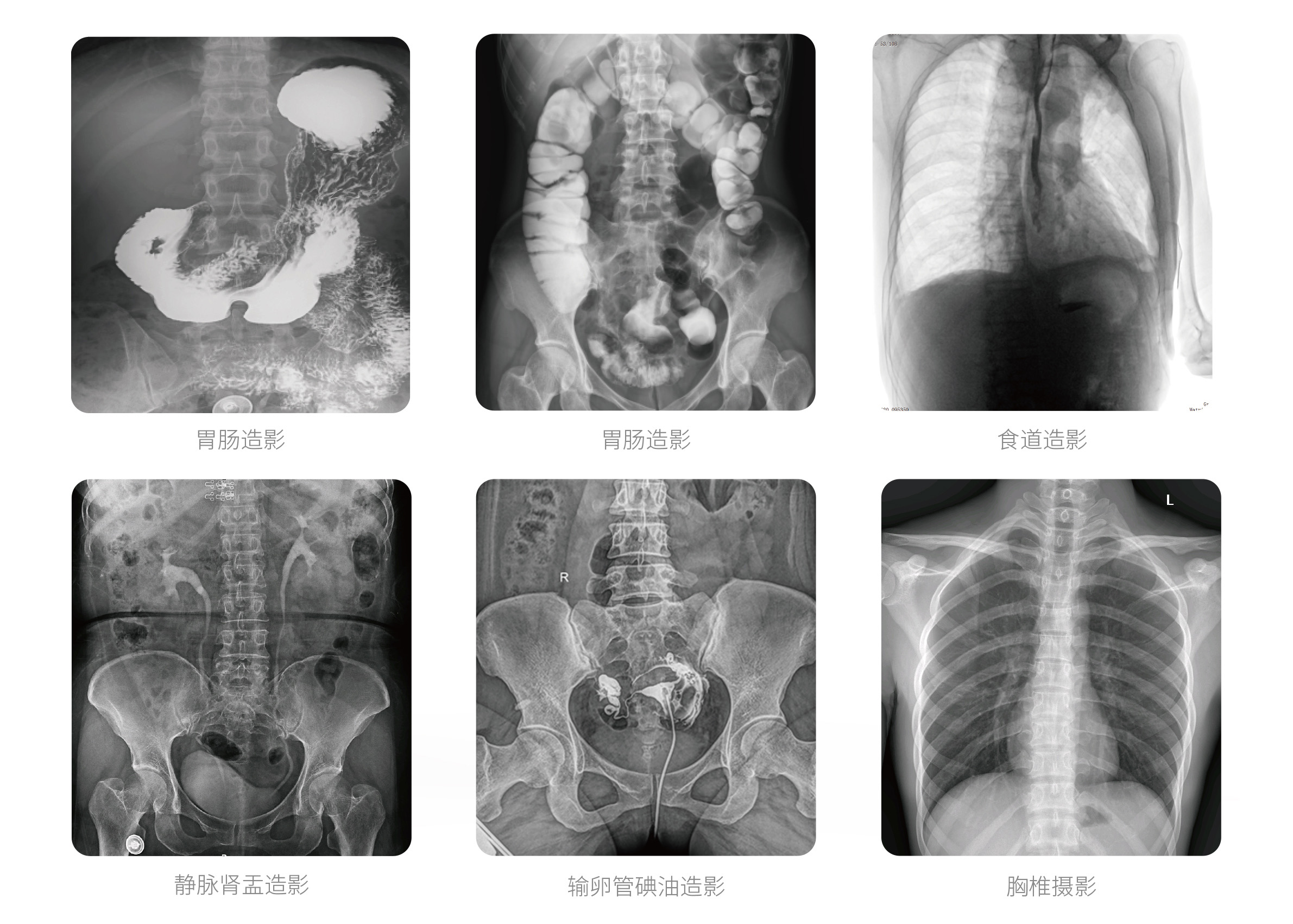 PLX8500E動態U臂DR臨床影像