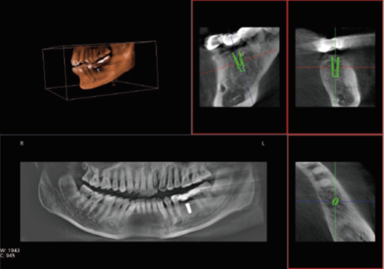 口腔CT圖像