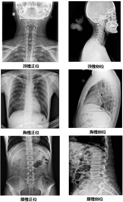 國產無線懸吊dr部分臨床效果圖