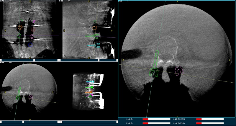 機器人輔助腰椎后路側彎矯形手術規劃圖像
